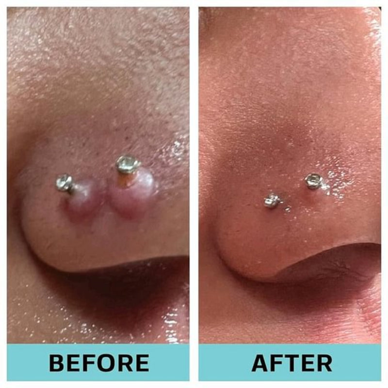 Keloid Bump Removal - Soothing Essential Oil