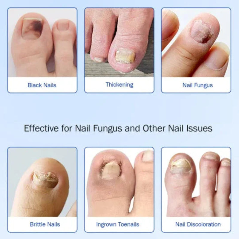 Fungal Nail Patches, 21pcs/box Nail Health Care Patches, Nail Fungus Care Patches, Suitable for Solving Fungal Nails and Other Nail Problems, Nail Supplies, Daily Care Nails Kit Set-hz
