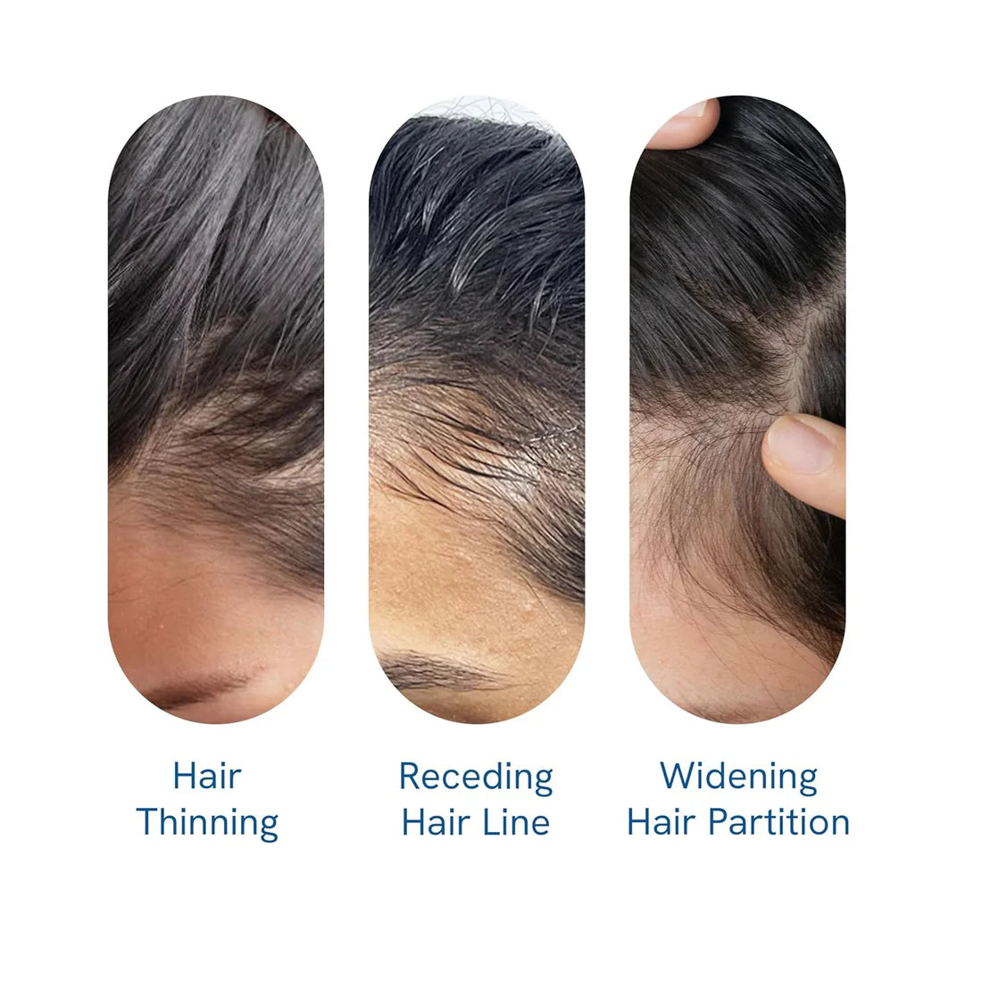 Be Bodywise Advanced Hair Growth Roll-On Serum | 3% Rosemary | 2% Aminexil | 3% Redensy l 2% Anagain | Precision Scalp Applicator | Paraben & Sulphate Free | Non oily and mess free-hz