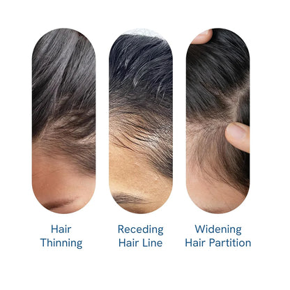 Be Bodywise Advanced Hair Growth Roll-On Serum | 3% Rosemary | 2% Aminexil | 3% Redensy l 2% Anagain | Precision Scalp Applicator | Paraben & Sulphate Free | Non oily and mess free-hz