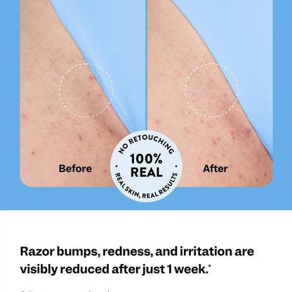 Smoothing Solution Ingrown Hair Treatment: Glide Your Way to Silky-Smooth, Bump-Free Skin